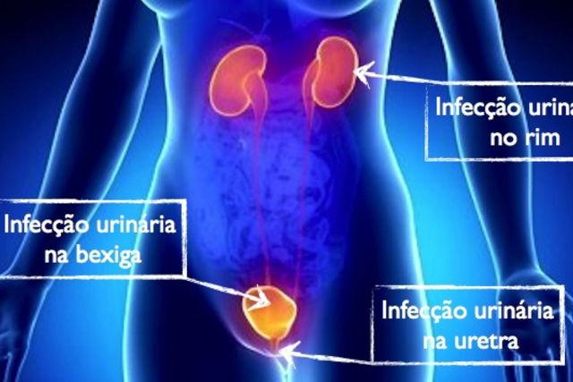 Infecção urinária - Nefrologista em Recife - Dra. Camila Barbosa Lyra