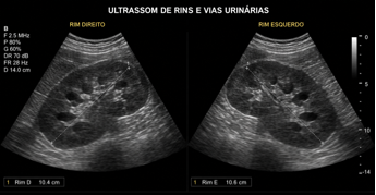 Doença Renal Crônica - Nefrologista em Recife Dra. Camila Barbosa Lyra